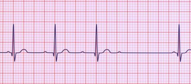 AV bloğu (Wenckebach) olan bir ECG 'yi 3D görselleştirme, kalp ritmindeki anormal elektrik iletimini vurguluyor.