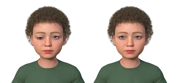 Child Hypotropia Same Healthy Man Illustration Displaying Downward Eye Misalignment — Stock Photo, Image