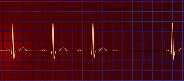 心臓リズムにおける異常な電気伝導を強調する 第2次Avブロック ウェンクバッハ を用いたEcgを可視化した3Dイラスト — ストック写真