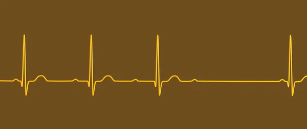 Ilustrace Zobrazující Ekg Blokem Stupně Wenckebach Zvýrazňující Abnormální Elektrické Vedení — Stock fotografie