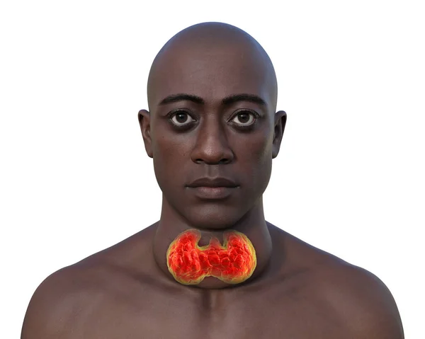 Man Enlarged Thyroid Gland Exophthalmos Photorealistic Illustration — Stock Photo, Image
