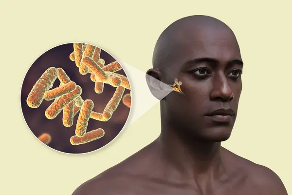 男性のOtitisメディア耳の感染 および細菌のクローズアップビュー 中耳炎のエチオピック剤 3Dイラスト — ストック写真