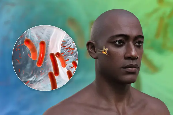 Otitis media ear infection in a man, and close-up view of bacteria, the etiological agents of the middle ear inflammation, 3D illustration.