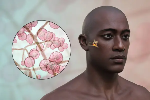 慢性真菌性中耳炎感染 显示中耳发炎的三维图片说明和白念珠菌的近视 这是慢性化脓性中耳炎的常见原因 — 图库照片