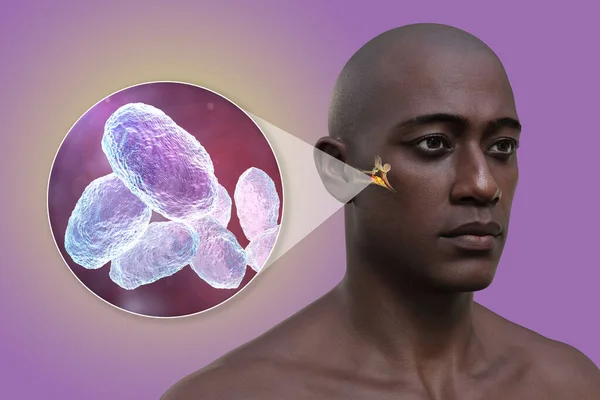 男性のOtitisメディア耳の感染 および中耳炎の一般的なエチオロジー剤であるバクテリアHemophilusインフルエンザのクローズアップビュー 3Dイラスト — ストック写真