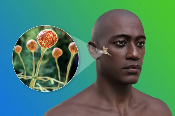 真菌性化脓性中耳炎感染及中耳粘液菌病的致病因子Mucor真菌的近视 3D说明 — 图库照片