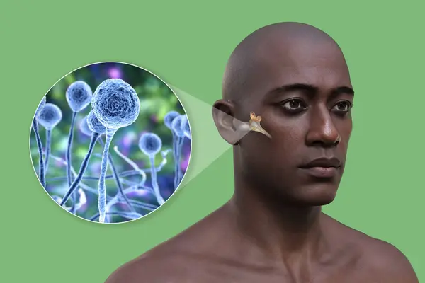 真菌性化脓性中耳炎感染及中耳粘液菌病的致病因子Mucor真菌的近视 3D说明 — 图库照片