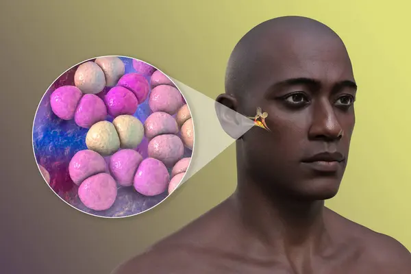 男性のOtitisメディア耳の感染 および中耳炎の共通のエチオロジー剤である細菌ストリプトカス肺炎のクローズアップビュー 3Dイラスト — ストック写真