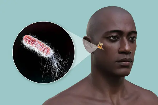 Zapalenie Ucha Środkowego Zapalenie Ucha Zbliżenie Widok Bakterii Pseudomonas Aeruginosa — Zdjęcie stockowe