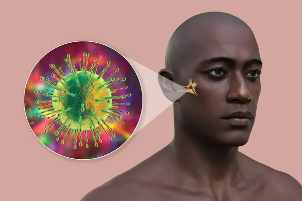 男子病毒性中耳炎 中耳发炎 引起耳痛和潜在听力问题 3D插图 — 图库照片