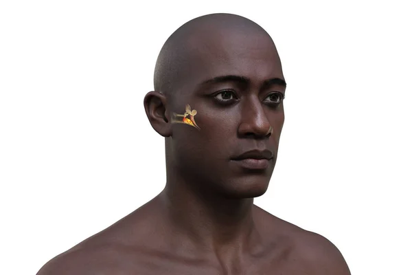 男性中耳炎 一种中耳的炎症 常由感染引起 引起耳痛和潜在的听觉问题 3D插图 — 图库照片