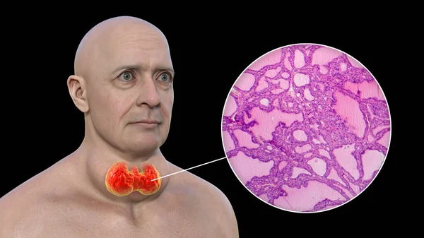 Illustration Man Enlarged Thyroid Gland Exophthalmos Alongside Micrograph Image Thyroid — Stock Photo, Image