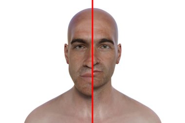 Bir erkekte akromegali ve aynı sağlıklı adam. 3 boyutlu illüstrasyon, hipofiz bezinin tümöründen kaynaklanan aşırı somatotrofin üretimi sonucu ellerin ve yüzün boyutunda bir artış olduğunu gösteriyor..