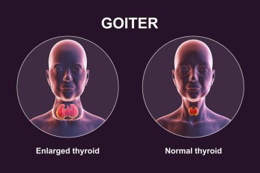 Tiroid bezleri büyümüş bir insan ve karşılaştırma için aynı sağlıklı kişi. Tedavi öncesi ve sonrası kavramsal 3D illüstrasyon.