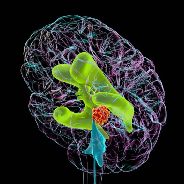 Beynin genişlemiş yanal ve üçüncü ventriküllerini (yeşille gösterilen hidrosefalus) betimleyen 3 boyutlu bilimsel bir illüstrasyon, beyin tümörünün serebral su kemerine (kırmızı ile) baskı yapmasından kaynaklanır.).