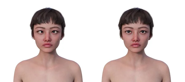 Žena Esotropií Stejnou Zdravou Osobou Ilustrace Ukazující Zarovnání Vnitřního Oka — Stock fotografie