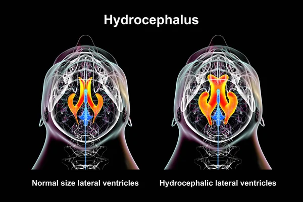 Vitenskapelig Illustrasjon Som Viser Forstørrede Laterale Ventrikler Hjernen Hydrocephalus Høyre – stockfoto