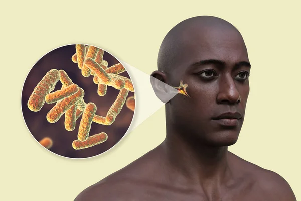 Bir Erkekte Kulak Iltihabı Bakterilere Yakından Bakmak Orta Kulak Iltihabının — Stok fotoğraf