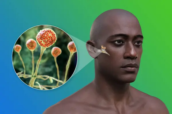 真ん中の耳の耳感染症 ミクロ菌のクローズアップビュー 3Dイラスト — ストック写真