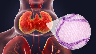 Tiroid bezi büyümüş bir insanın 3 boyutlu bir çizimi ve tiroid dokusunun yerel guatr tarafından etkilenmiş bir mikro-grafik görüntüsü..