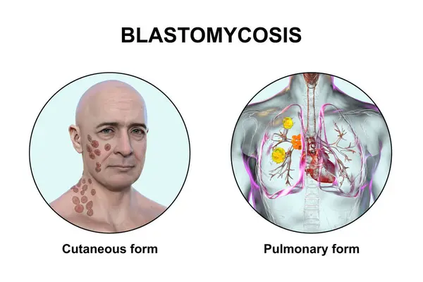 Clinical Forms Blastomycosis Cutaneous Pulmonary Blastomycosis Illustration — Stock Photo, Image