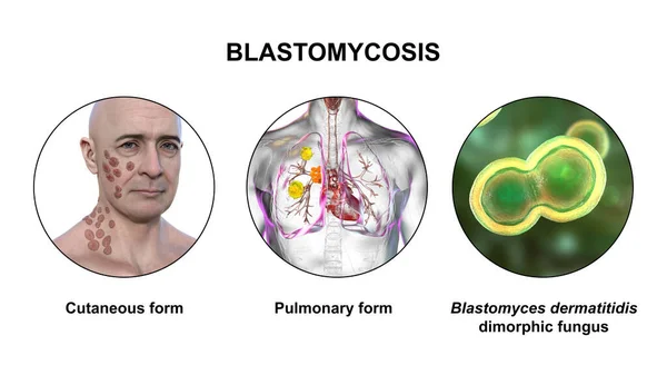 Blastomikozun Klinik Formları Cutaneous Pulmoner Blastomycosis Blastomyces Dermatidis Mantarlarına Yakın — Stok fotoğraf