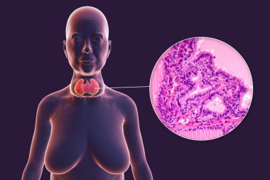 Tiroid bezi ve exophthalmos 'u büyümüş bir kadın hastanın 3 boyutlu bir çizimi ve toksik guatr tarafından etkilenmiş tiroid dokusunun mikro grafiği..