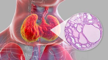 Tiroid bezi büyümüş bir insanın 3 boyutlu bir çizimi ve tiroid dokusunun yerel guatr tarafından etkilenmiş bir mikro-grafik görüntüsü..