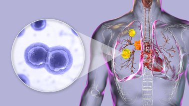 Akciğer lezyonları ve genişlemiş bronşiyal lenf bezleriyle pulmoner blastomikoz ve Blastomyces dermatidis 'in yakın plan görüntüsü, 3 boyutlu illüstrasyon..