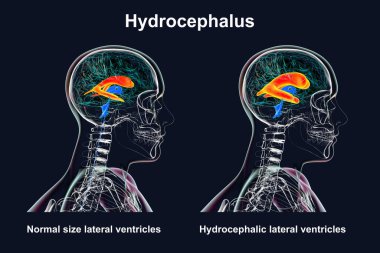 İnsan beyninin genişlemiş yanal ventriküllerini (hidrosefalus, turuncu ile gösterilen sağ taraf) ve normal yanal ventrikülleri (sol taraf) gösteren bilimsel bir tasvir..