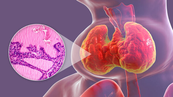 3D иллюстрация человека с увеличенной щитовидной железой, наряду с микрографическим изображением ткани щитовидной железы, пораженной токсичным зоб.