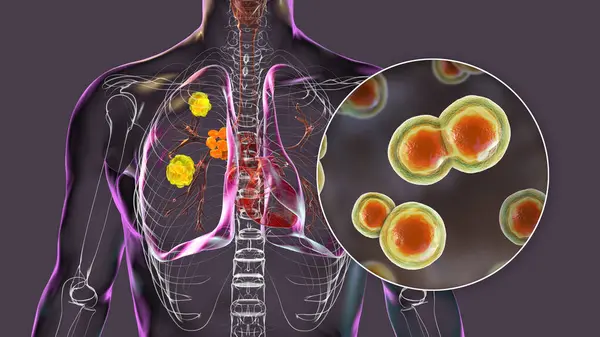 Akciğer Lezyonları Genişlemiş Bronşiyal Lenf Bezleriyle Pulmoner Blastomikoz Blastomyces Dermatidis — Stok fotoğraf
