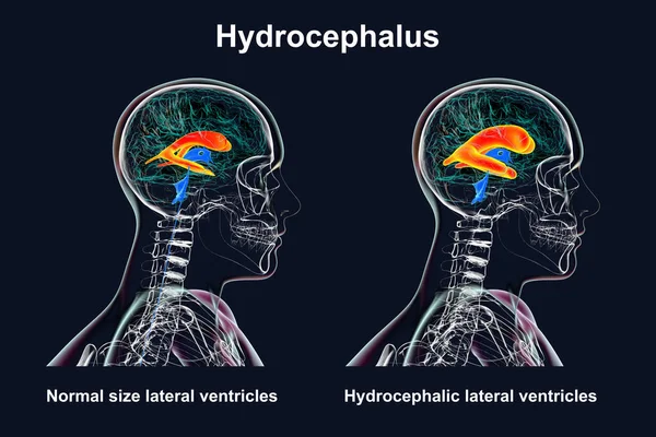Una Ilustración Científica Que Representa Ventrículos Laterales Agrandados Del Cerebro — Foto de Stock