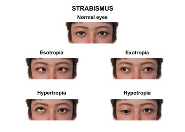 Çeşitli strabismus tiplerine sahip bir kadının notlu 3D çizimi: esotropia, exotropia, hypertropia ve hipotropia.