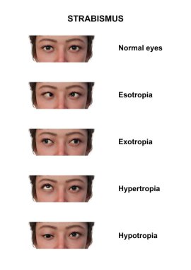 Çeşitli strabismus tiplerine sahip bir kadının notlu 3D çizimi: esotropia, exotropia, hypertropia ve hipotropia.