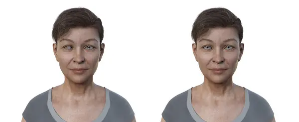 Kobieta Ezotropią Samą Zdrową Osobą Ilustracja Pokazująca Wewnętrzne Niewspółosiowość Oczu — Zdjęcie stockowe