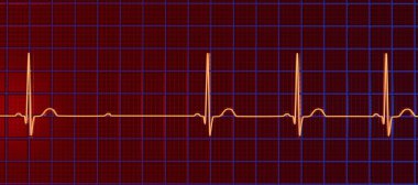 3D illüstrasyon, kalp ritmindeki anormal elektriksel iletimi vurgulayan, 2. derece AV bloğu (Mobitz 2) ile bir ECG görselleştirme.