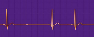 3D illüstrasyon, kalp ritmindeki anormal elektriksel iletimi vurgulayan, 2. derece AV bloğu (Mobitz 2) ile bir ECG görselleştirme.