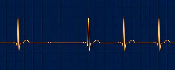 Illüstrasyon Kalp Ritmindeki Anormal Elektriksel Iletimi Vurgulayan Derece Bloğu Mobitz — Stok fotoğraf