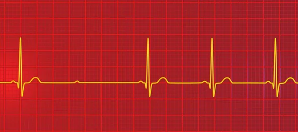 心臓リズムにおける異常な電気伝導を強調する 第2次Avブロック モビッツ2 を用いたEcgを可視化した3Dイラスト — ストック写真