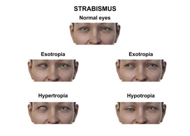 Çeşitli strabismus tiplerine sahip bir kadının notlu 3D çizimi: esotropia, exotropia, hypertropia ve hipotropia.