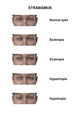 Çeşitli strabismus tiplerine sahip bir kadının notlu 3D çizimi: esotropia, exotropia, hypertropia ve hipotropia.