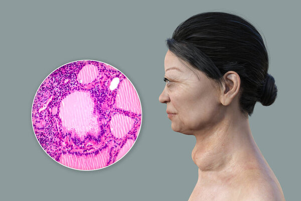 3D-иллюстрация пациентки с увеличенной щитовидной железой и экзофтальмозом, наряду с микрографическим изображением ткани щитовидной железы, пораженной токсичным зоб.