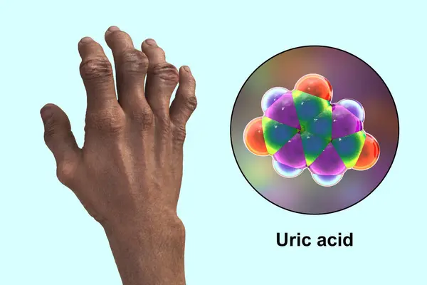 Vědecká Ilustrace Zobrazující Ruce Postižené Dnou Deformitami Detailním Pohledem Molekulu — Stock fotografie