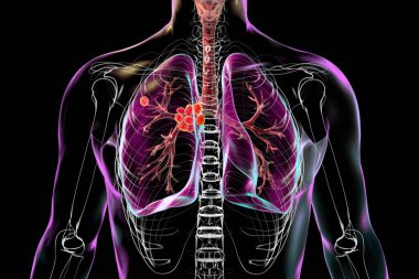 Birincil akciğer tüberkülozu, Ghon kompleksi ve mediastal lenf iltihabı içeren üç boyutlu illüstrasyon..