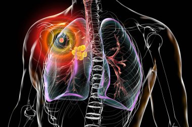 Birincil akciğer tüberkülozu, Ghon kompleksi ve mediastal lenf iltihabı içeren üç boyutlu illüstrasyon..