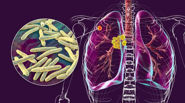 Primary Lung Tuberculosis Illustration Featuring Ghon Complex Mediastinal Lymphadenitis Alongside — Stock Photo, Image