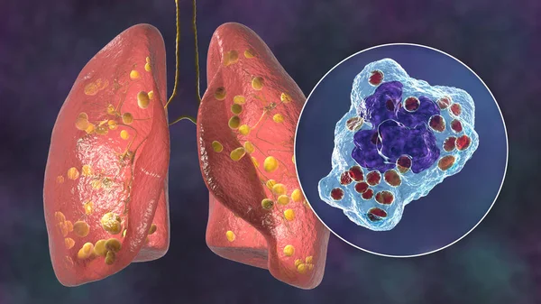 Lung histoplasmosis, a fungal infection caused by Histoplasma capsulatum. 3D illustration showing small nodules scattered in the lungs and close-up view of Histoplasma yeasts inside lung macrophages.