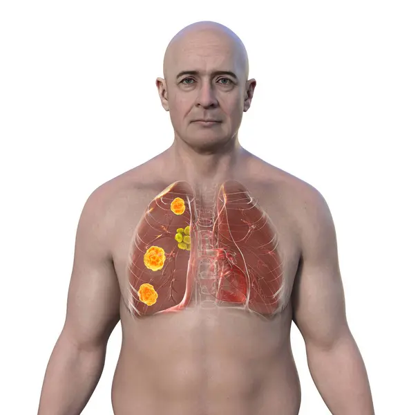 Pulmonary Blastomycosis Lung Lesions Enlarged Bronchial Lymph Nodes Illustration — Stock Photo, Image