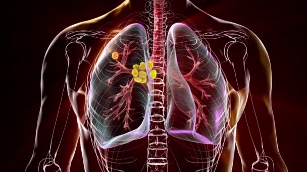 Primäre Lungentuberkulose Animation Des Ghon Komplexes Und Der Mediastinalen Lymphadenitis — Stockvideo